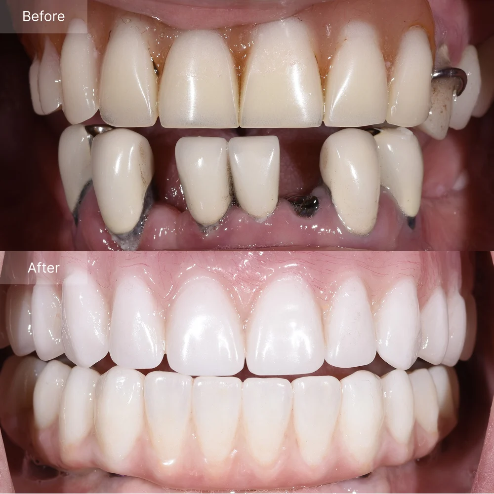 Before and after full arch implant reconstruction — failing teeth transformed into a bright, natural zirconia smile